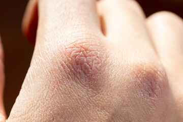 Close up of dry cracked skin on a young male hands isolated, outdoor with daylight. Pain for dehydratation. Dermatology concept. Skin texture