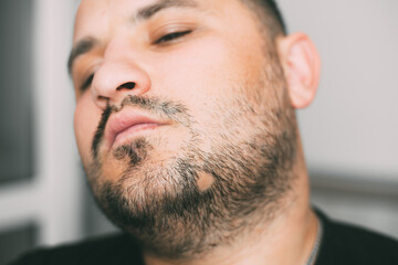 Alopecia areata on a man beard. Receding, face