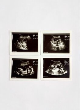 Ultrasound scans of a pregnant woman, from conception to the third trimester of pregnancy