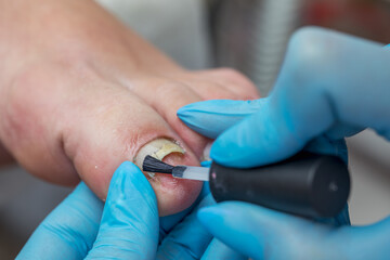 The pedicurist covers the skin with anti-fungus medicine. The problem of onycholysis on the nails.
