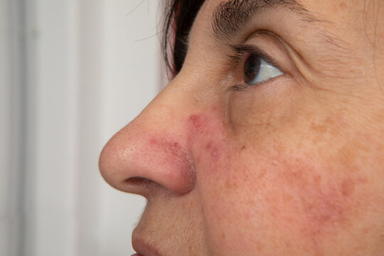 Redness and visible blood vessels on woman face skin