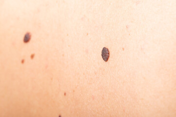 Woman with birthmark on her back, skin tags removal - cosmetic surgery