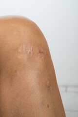 scratch wound on knee with big scar closeup, healthcare and medicine concept.