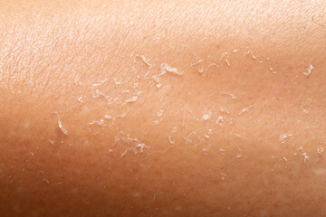 Fototapeta premium unhealthy human skin epidermis texture with flaking and cracked particles close-up