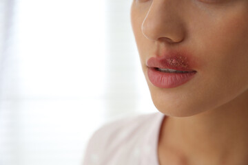 Woman with herpes on lip against light background, closeup - obrazy, fototapety, plakaty