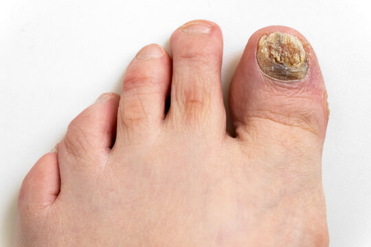 Sick nail on the foot. Toenail fungus on white background. Sore toenail, nail fungus close up.