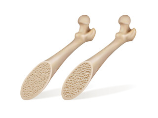 Medical illustration of healthy bone and bone of a patient with osteoporosis. Vector illustration