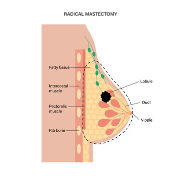 Breast disease concept