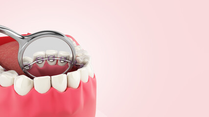Lingual braces system on a demonstration denture 3d close up on color gradient - 395346594