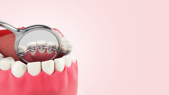 Lingual Braces System On A Demonstration Denture 3d Close Up On Color Gradient