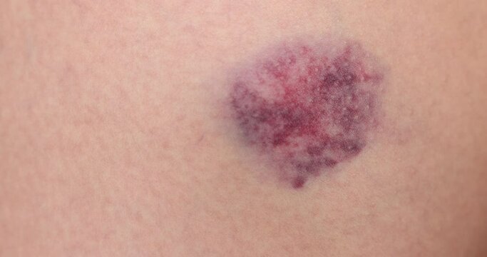 Close-Up on Bruise on Woman's leg