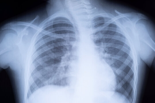 x-ray of the lungs of a teenager. Lung pathology.