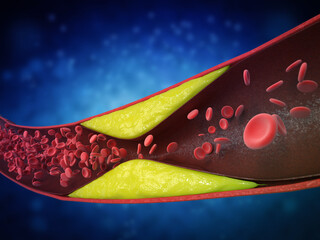 atherosclerosis with plaque in vessel