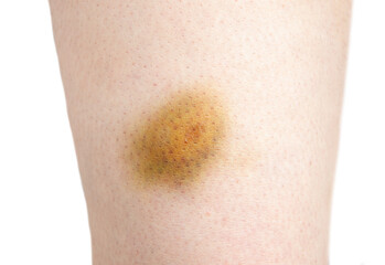 Close-up of bruise of hitting in the leg of woman on white background