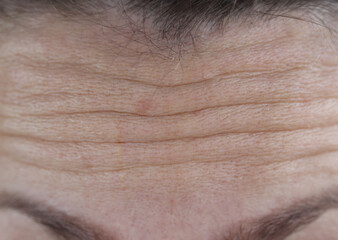 Facial wrinkles on forehead of adult woman closeup. Aesthetic medicine concept