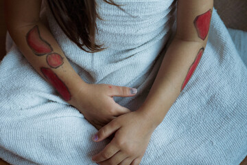 Sad and Frightened Little Girl with Bloodshot and Bruised spots on the body. Child abuse among...
