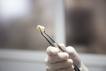 The nurse holds the extracted molar with tweezers.