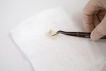 The nurse holds the extracted molar with tweezers on a table.