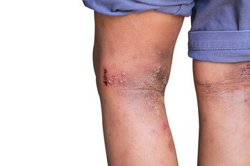 Close up on eczema, skin rash and atopic dermatitis on a boy's legs isolated on white black ground...