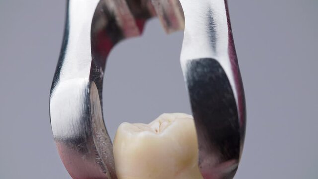 Fake removing wisdom tooth with dental metal forceps