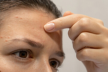 Close-up portrait of a girl squeezes out a pimple on her forehead. An awkward moment before a date