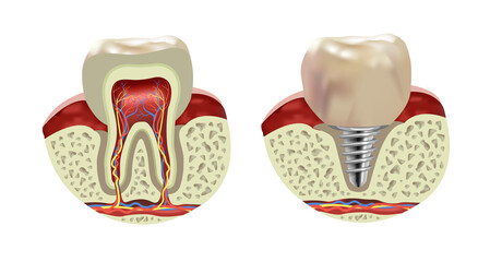 Artificial human tooth implant, cross section realistic view, vector illustration