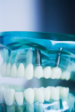 Dental tooth implant model