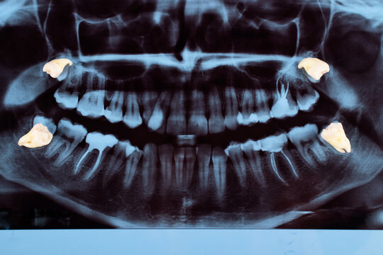 Dental panoramic x-ray. Medical concept. Dental treatment. Extraction of a wisdom tooth.