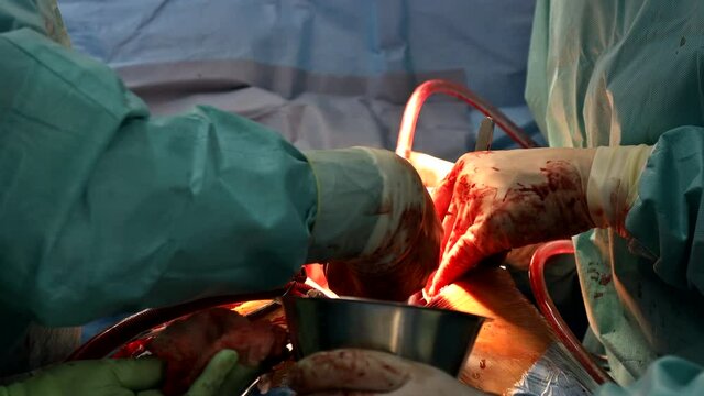 Surgeon doctors perform on open heart valve replacement surgery.