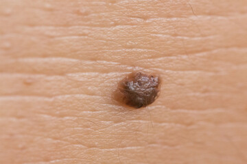 Intradermal nevus closeup view