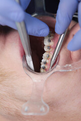 Correction of teeth of a person with an incorrect bite. The installation of braces. Vertical photo....