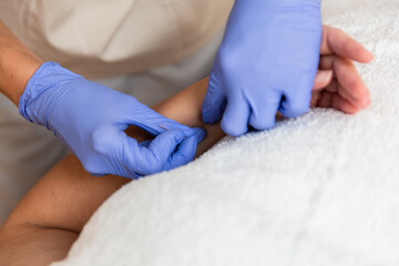 physiotherapist giving treatment with dry needling to patient