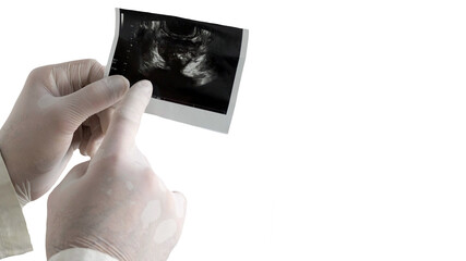 The picture of the prostate is isolated on a white background, male prostatitis picture at the...