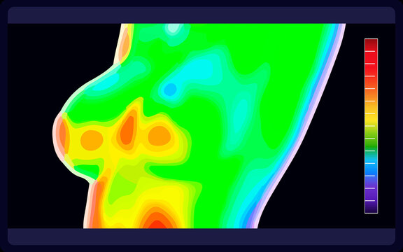 Vector graphic of Thermographic image of breast on black background. Woman's chest showing different temperatures in range of colors from blue showing cold to red showing hot. vector eps10.