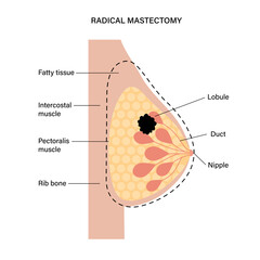 Breast disease concept