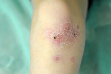 Fototapeta premium Healing wounds on the knee of a child.