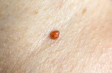 Big birthmark on skin. Medical health photo. Papillomas on human body.