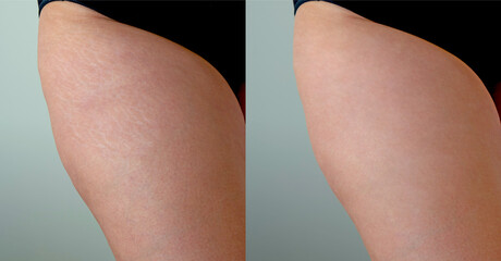 Image compare before and after Woman skin with stretch marks removal treatment, real people. Close...