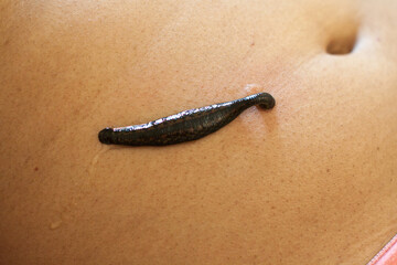 Leech theraphy on a stomach area