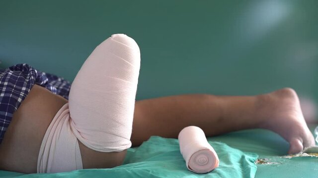 below knee amputee muscle training footage for BK prosthesis