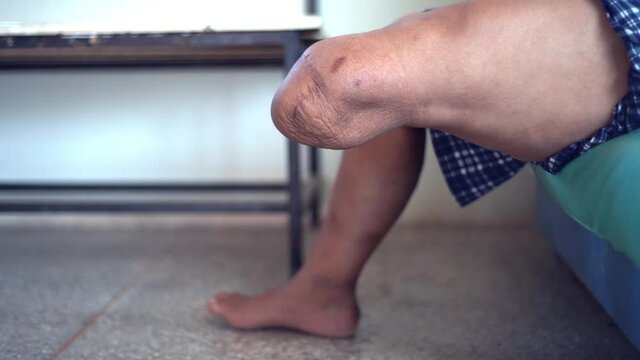 below knee amputee muscle training footage for BK prosthesis