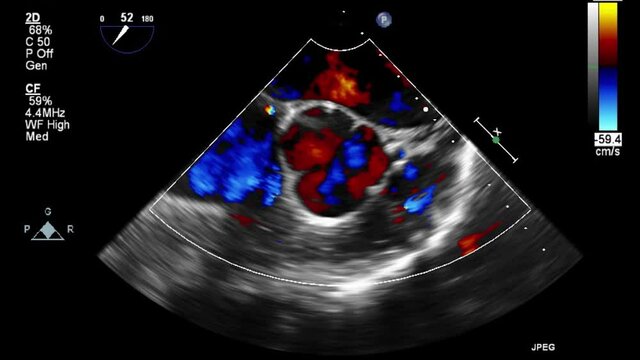 Transesophageal ultrasound video in Doppler mode.