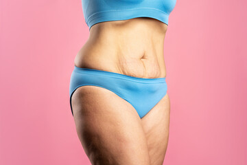 Tummy tuck, flabby skin on a fat belly, plastic surgery concept