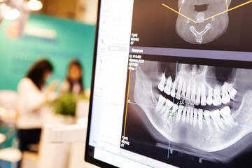 X-ray of the jaw with teeth on a computer monitor. Examination of the oral cavity using digital,...