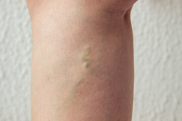 varicose veins on a woman leg, a node under the knee