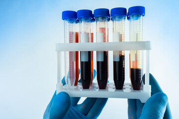Blood tests. Laboratory diagnostics. Checking the state of the body based on tests. Test tubes with...