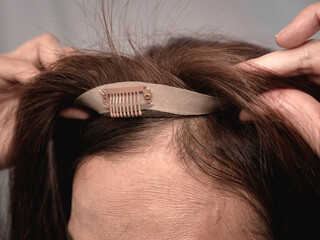 Demonstrating how to fix a toupee or hiar extension on a woman's scalp. A wig clip is visible in...