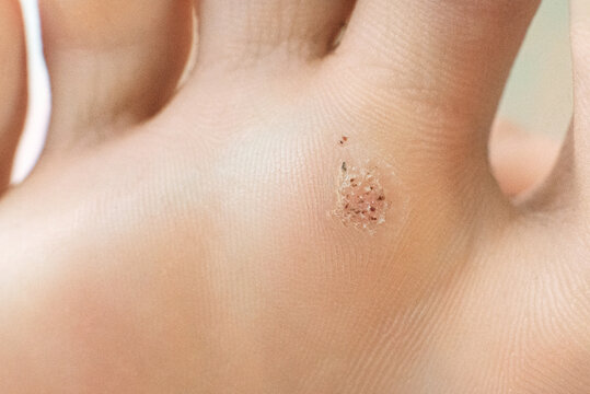 wart on a blunt close-up. Macro shot of human papilloma on the foot.