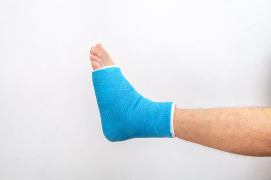 Man's leg in plaster cast and blue splint close up on white background.