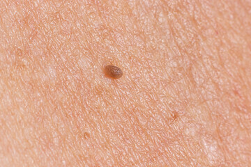 Papilloma on human skin - benign tumor in the form of mole, nevus Papillomatosis medicine